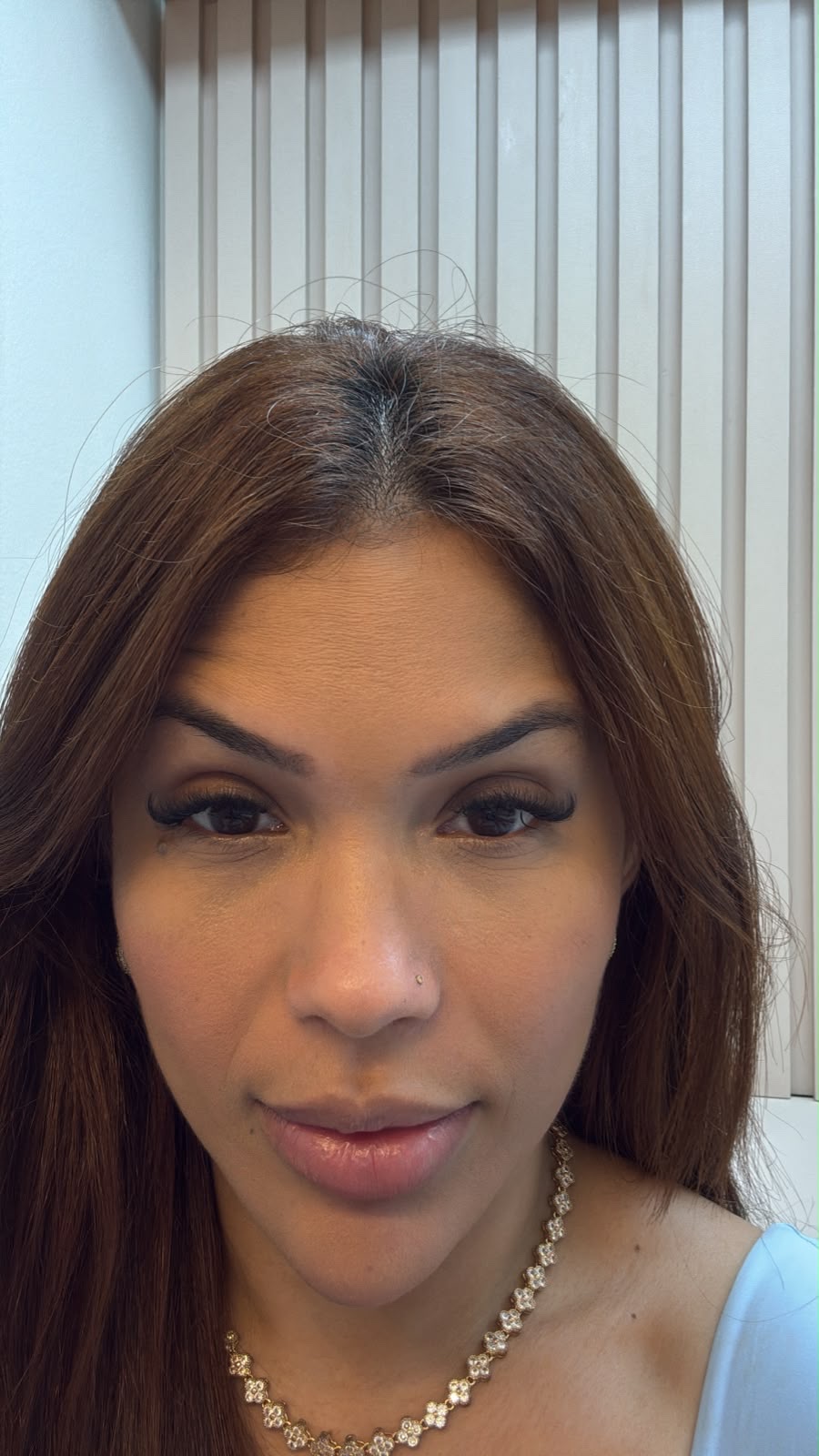 Depois do protocolo de expressão facial - paciente 2