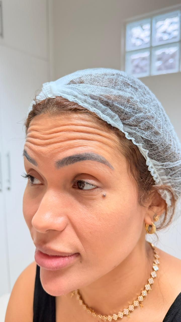 Antes do protocolo de expressão facial - paciente 2